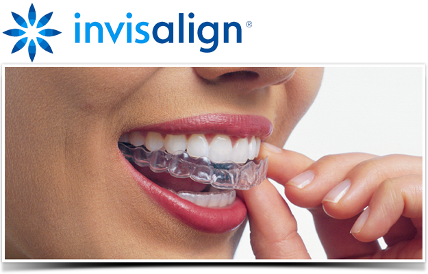 invisalign